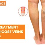Laser Treatment for Varicose Veins in Vizag