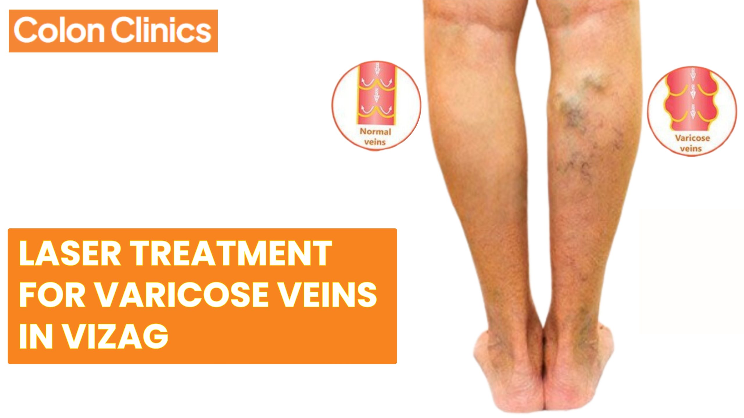 Laser Treatment for Varicose Veins in Vizag