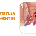 Laser Fistula Treatment in Vizag
