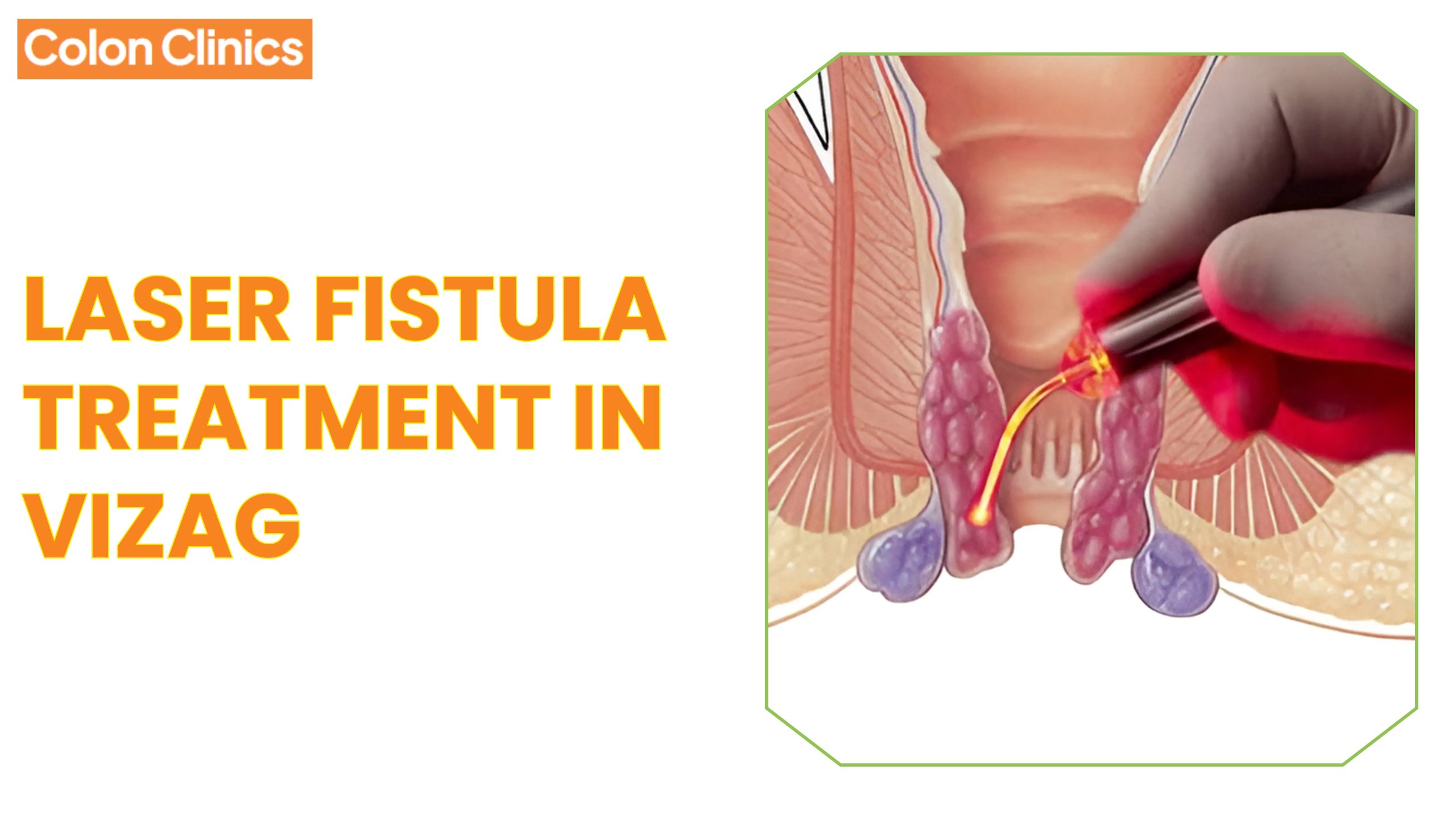 Laser Fistula Treatment in Vizag