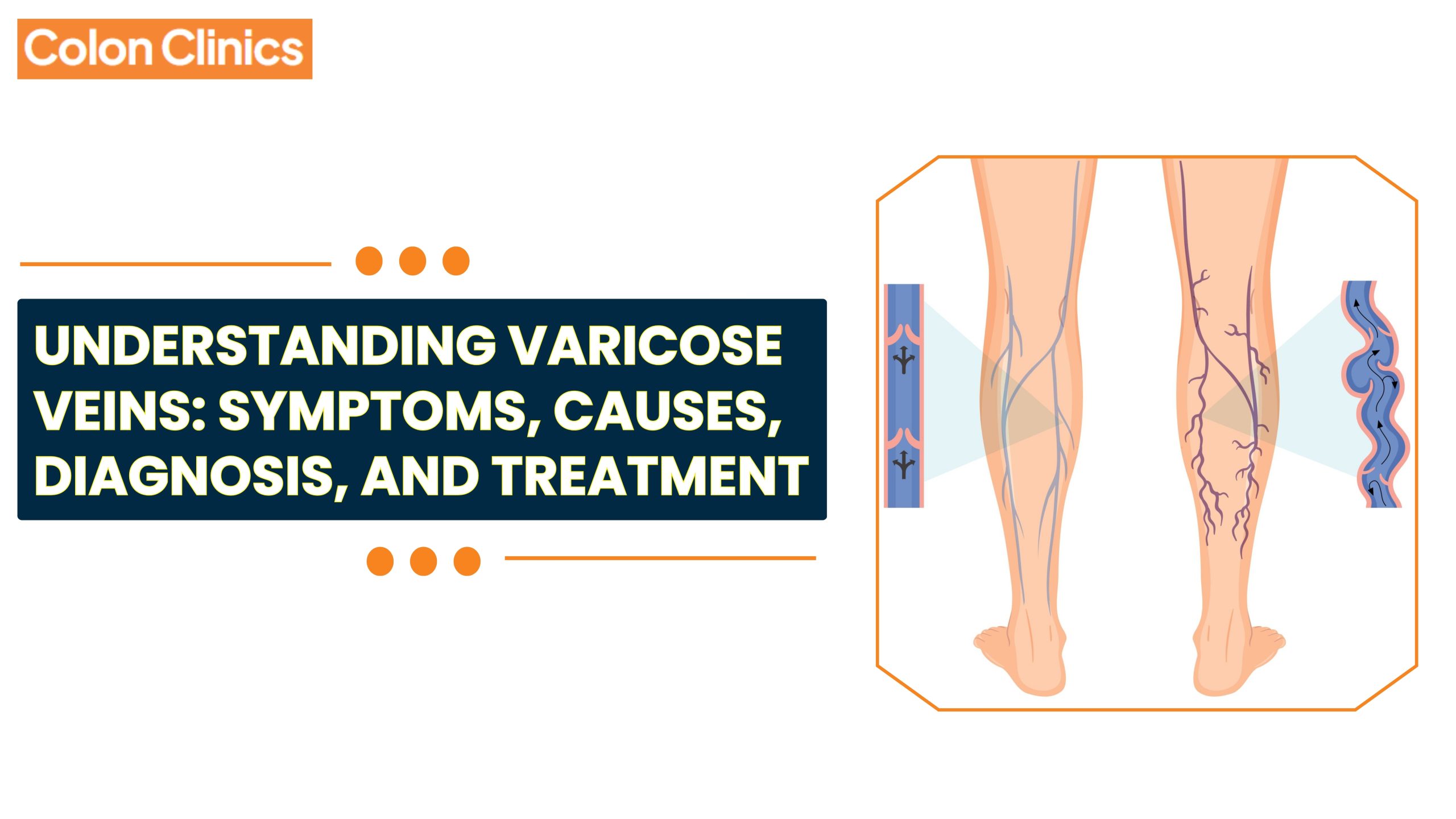 Best Varicose Veins Treatment in Vizag