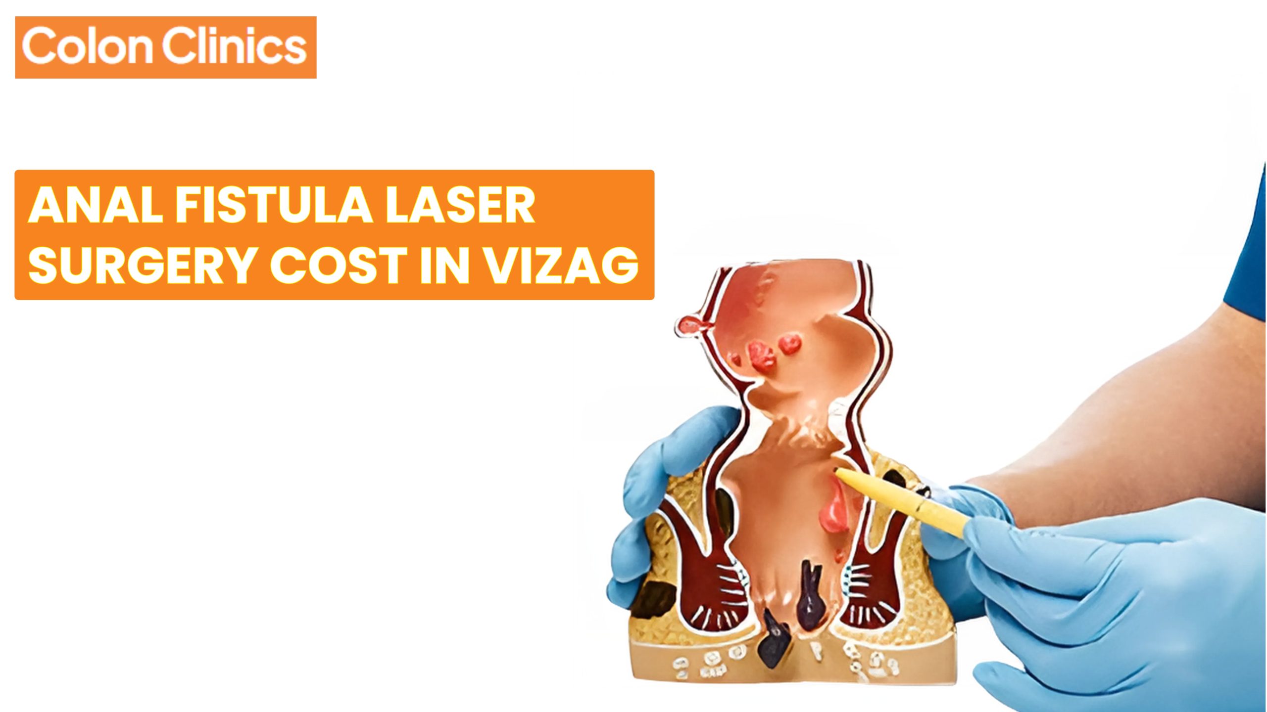 Anal Fistula Laser Surgery Cost in Vizag