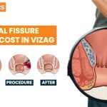 Laser Anal Fissure Surgery Cost in Vizag