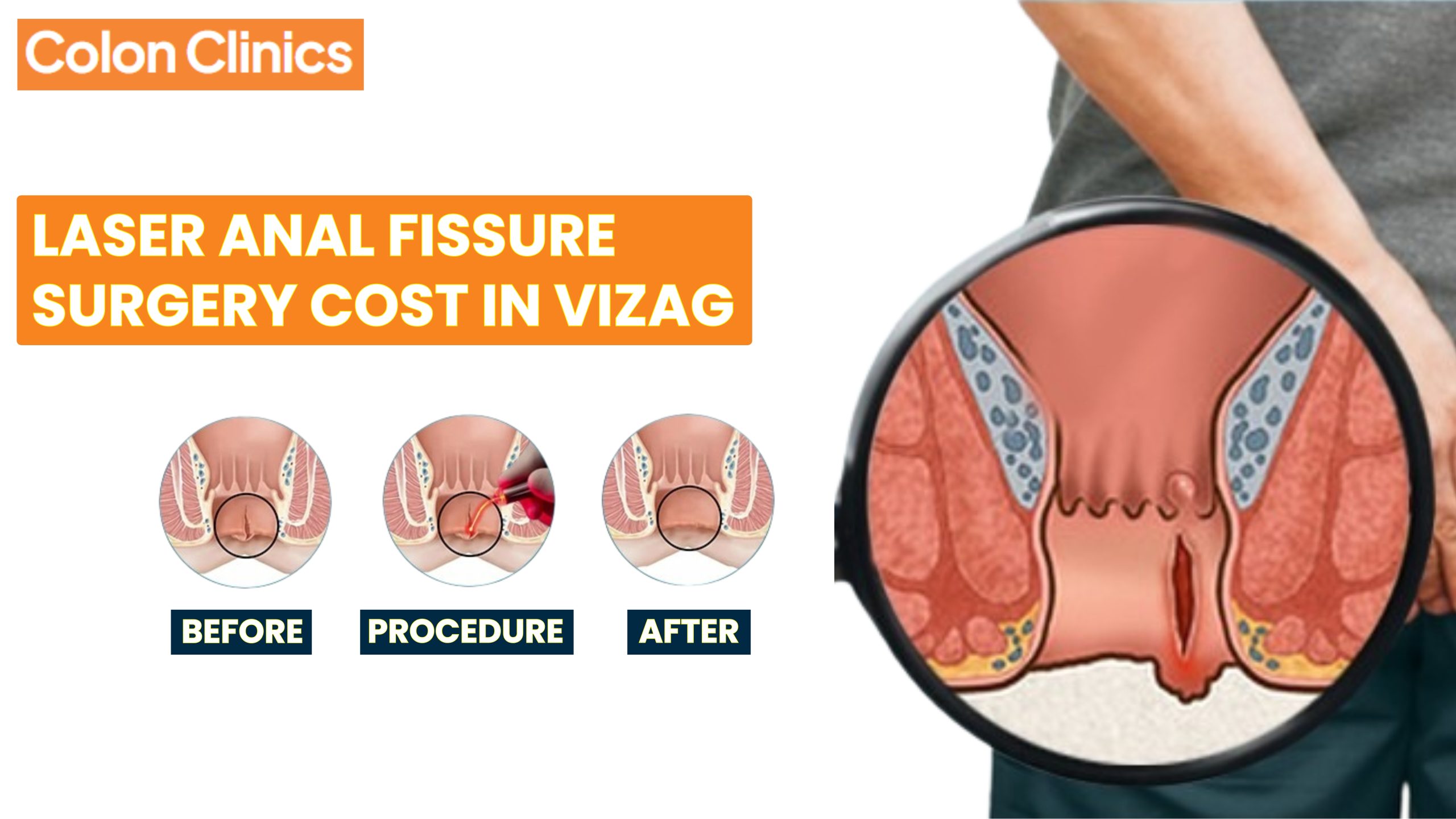 Laser Anal Fissure Surgery Cost in Vizag