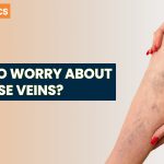 varicose veins treatment in Vizag
