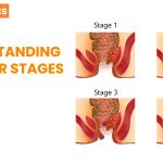 Piles Treatment in Vizag