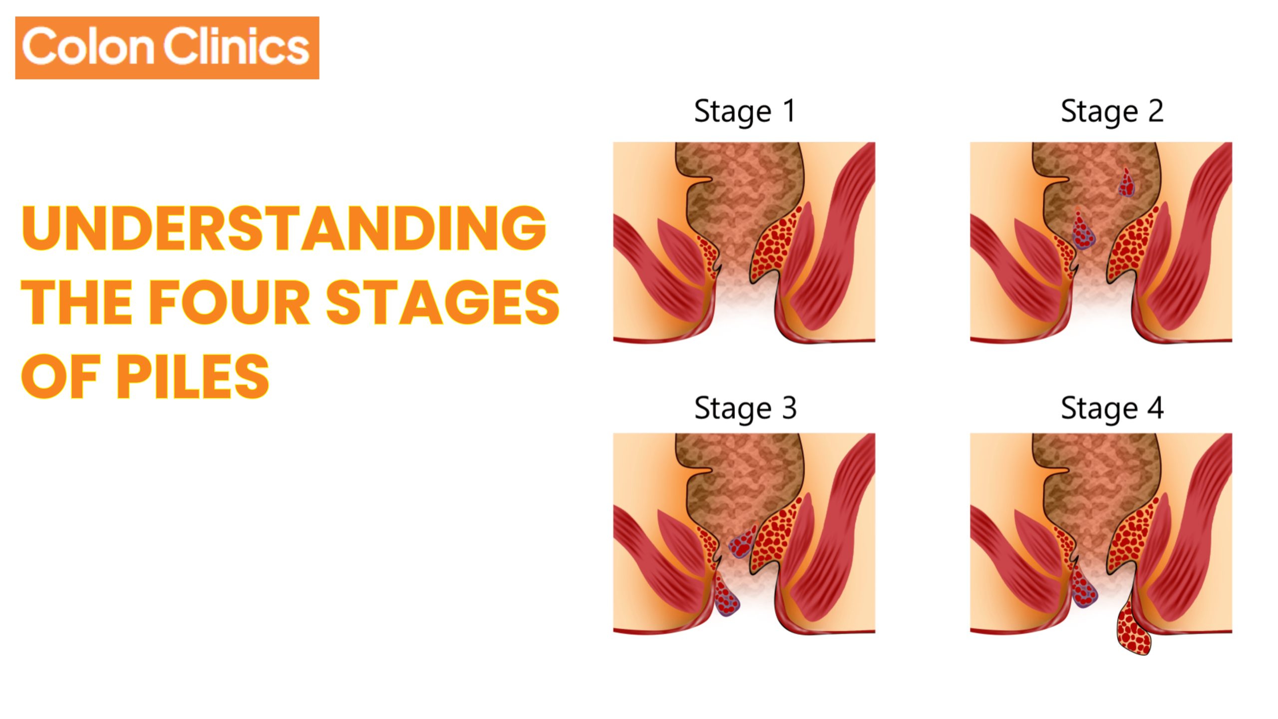 Piles Treatment in Vizag