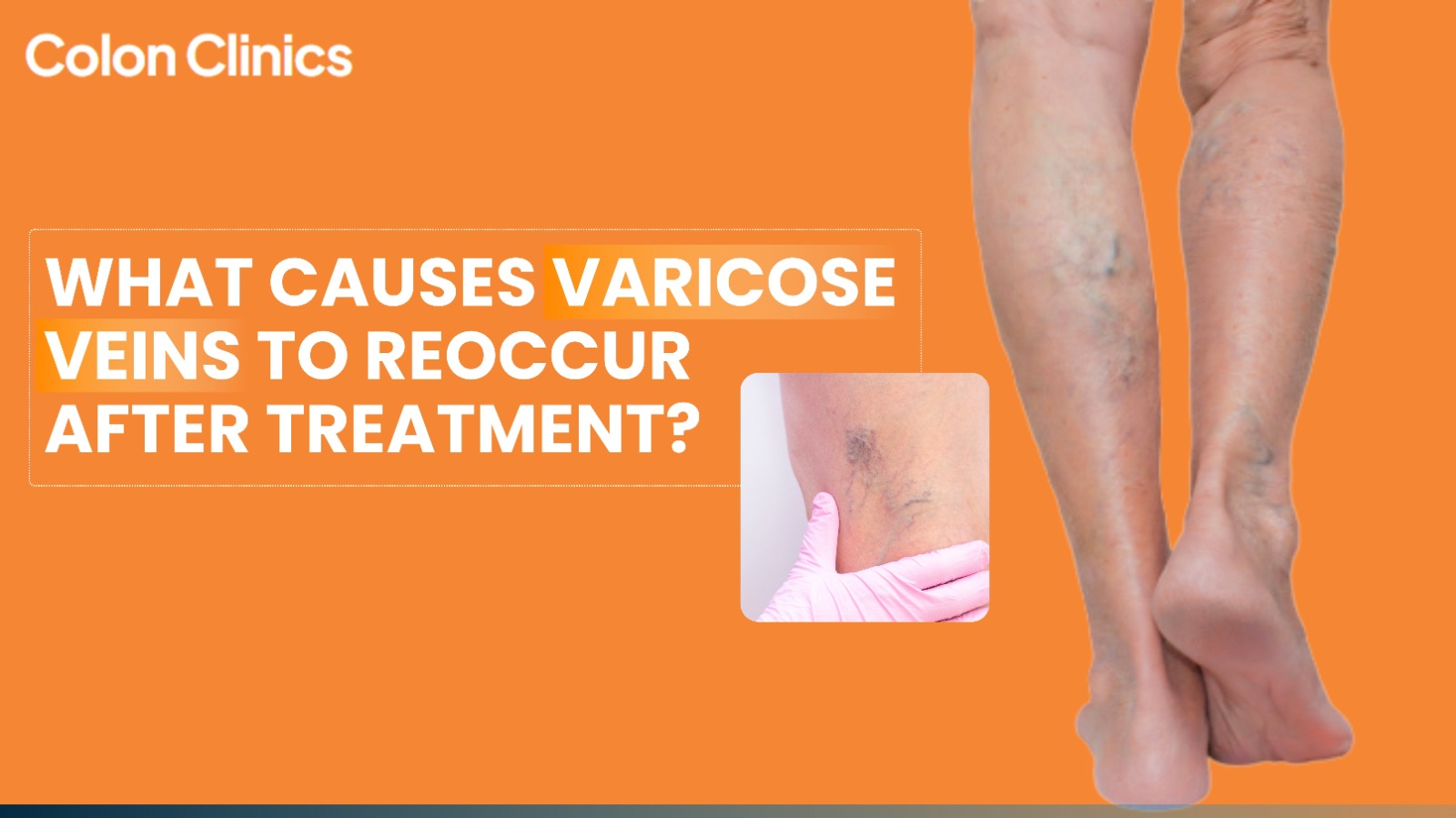 varicose vein treatment in Vizag