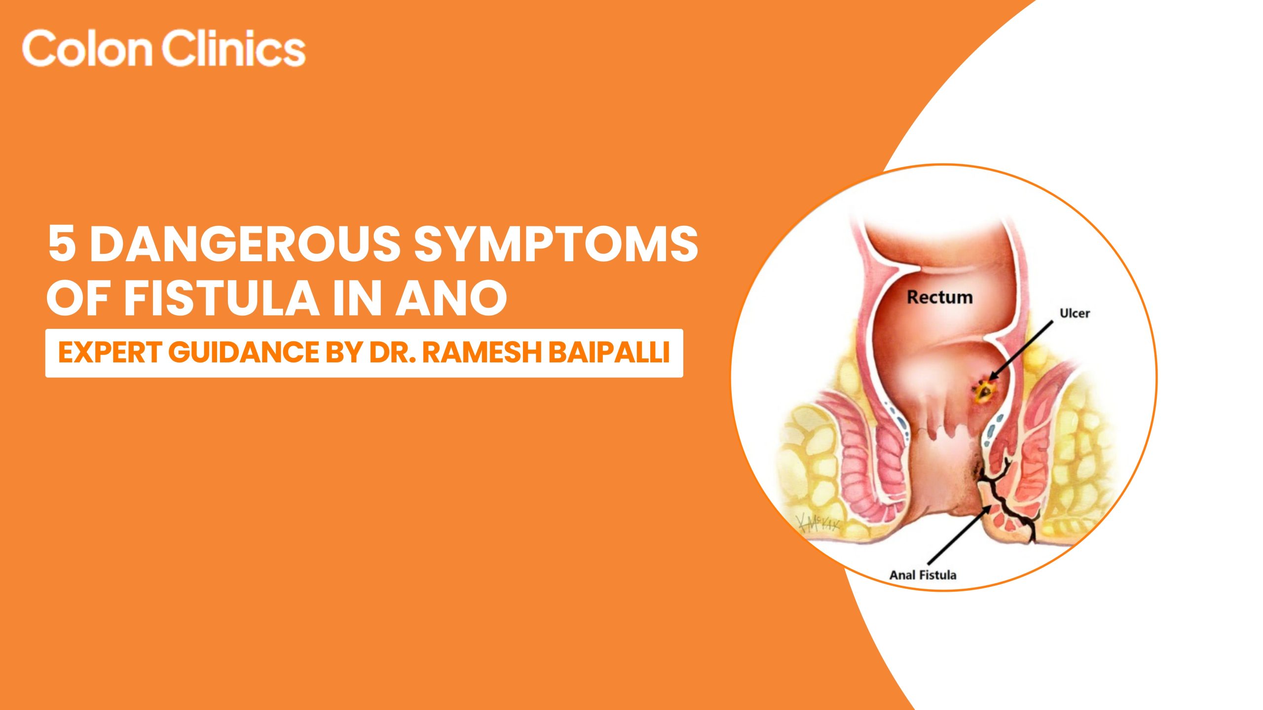 anal fistula treatment in Vizag