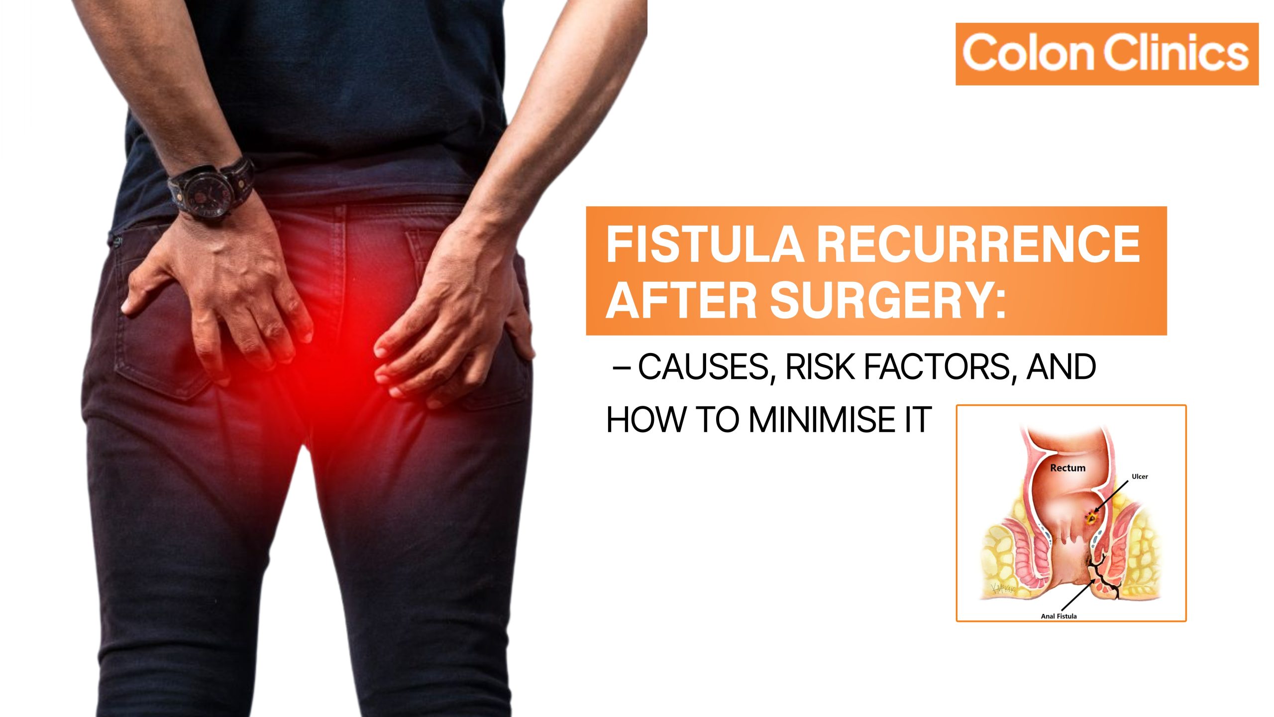 Fistula Recurrence After Surgery